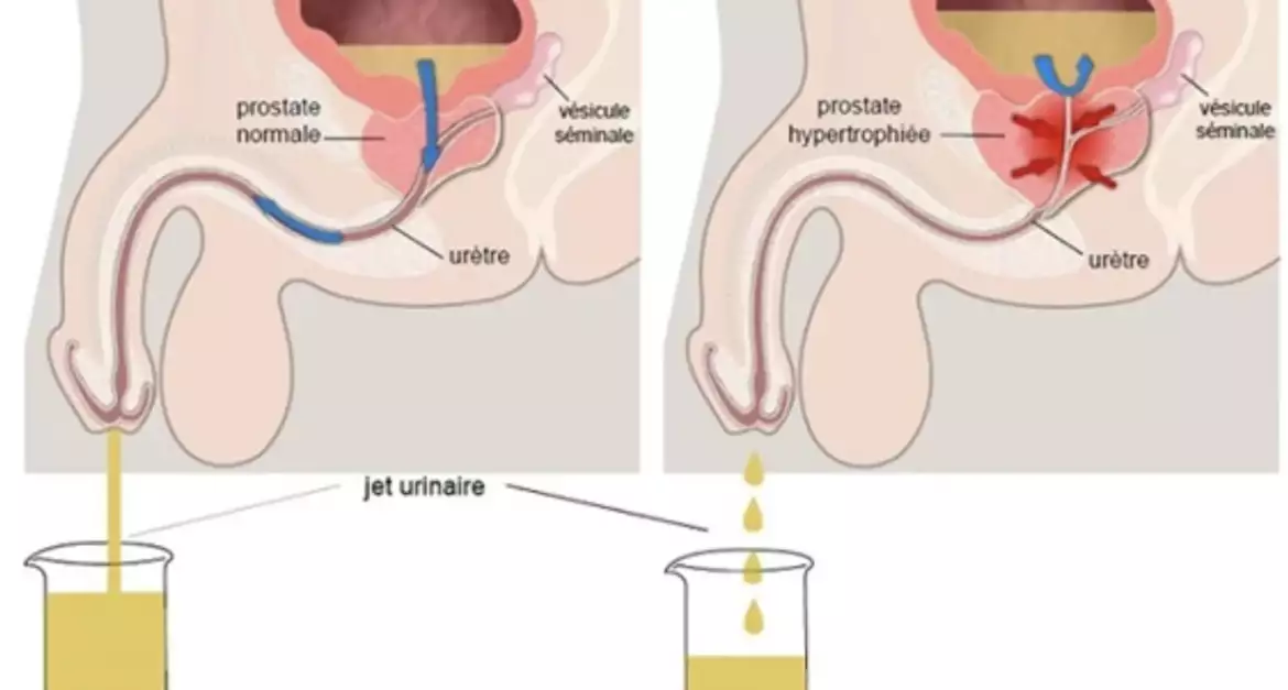 Schéma hypertrophie bénigne de la prostate (HBP)