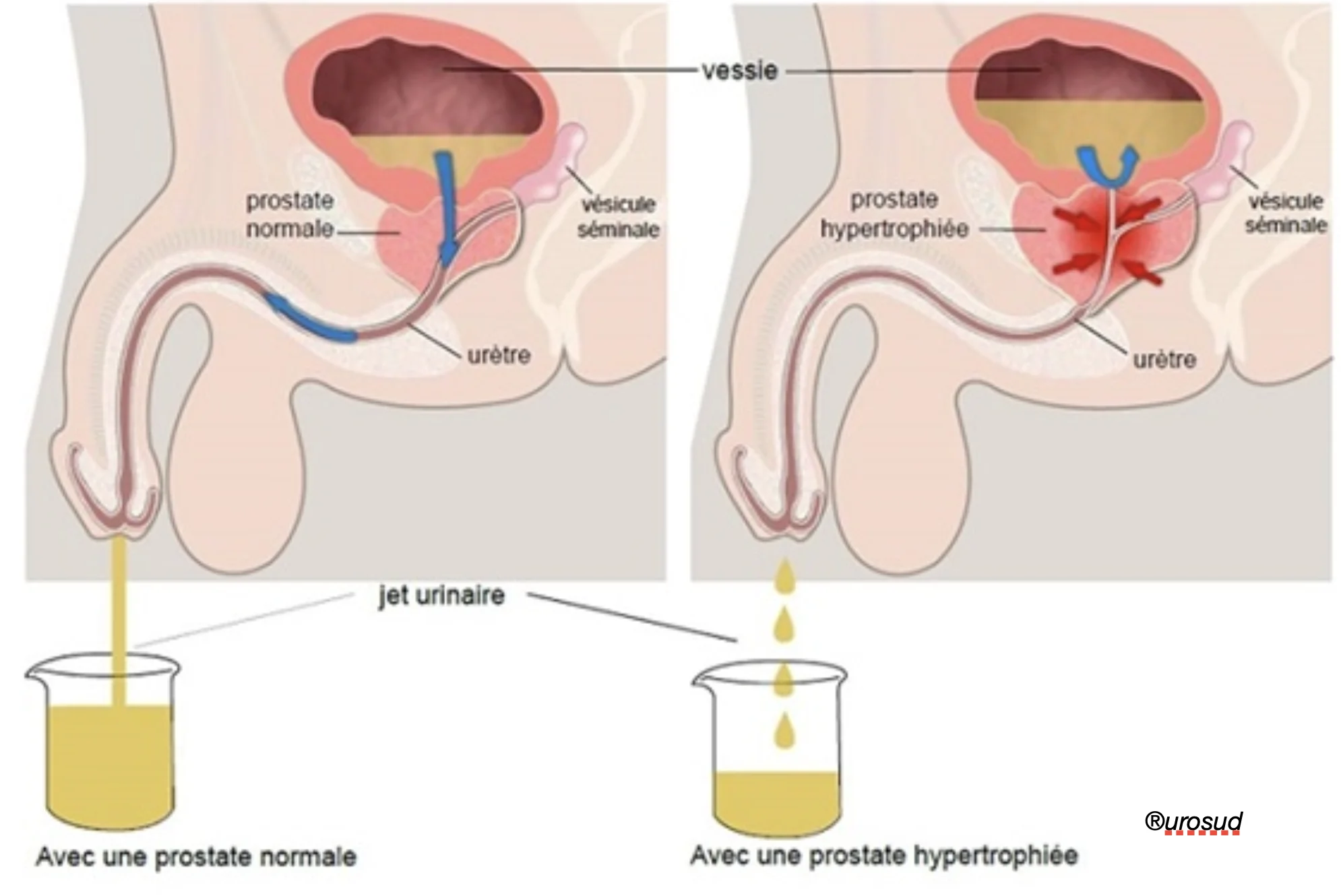 Schéma hypertrophie bénigne de la prostate (HBP) Schéma hypertrophie bénigne de la prostate (HBP)