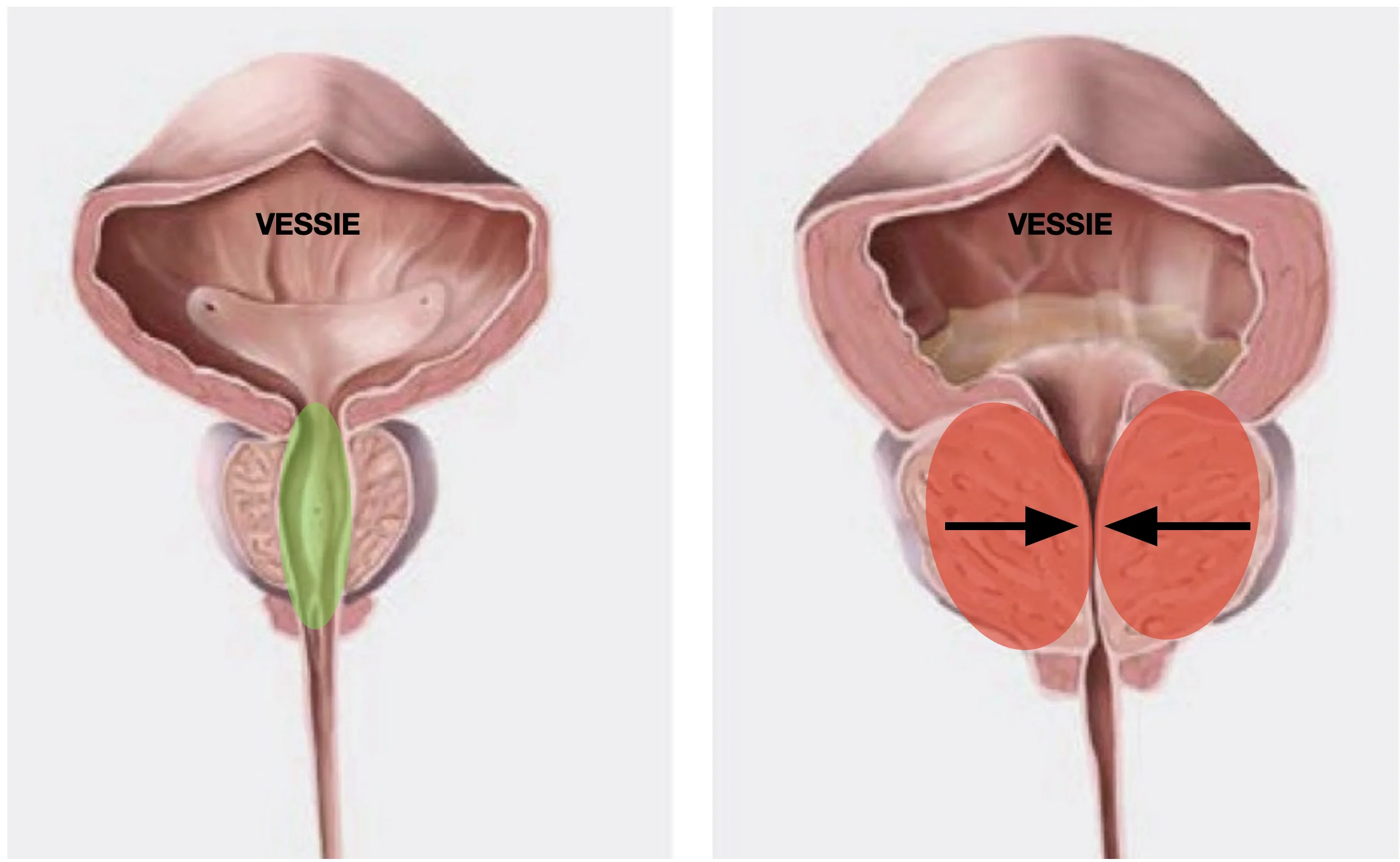 Schéma hypertrophie bénigne de la prostate (HBP) Schéma hypertrophie bénigne de la prostate (HBP)