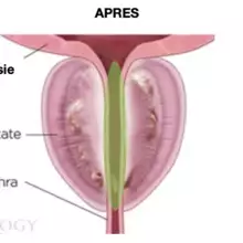 Schéma hypertrophie bénigne de la prostate (HBP) Schéma hypertrophie bénigne de la prostate (HBP)