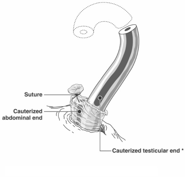 Vasectomy-procedure-with-thermal-cautery-combined-with-fascial-interposition-over-the.png