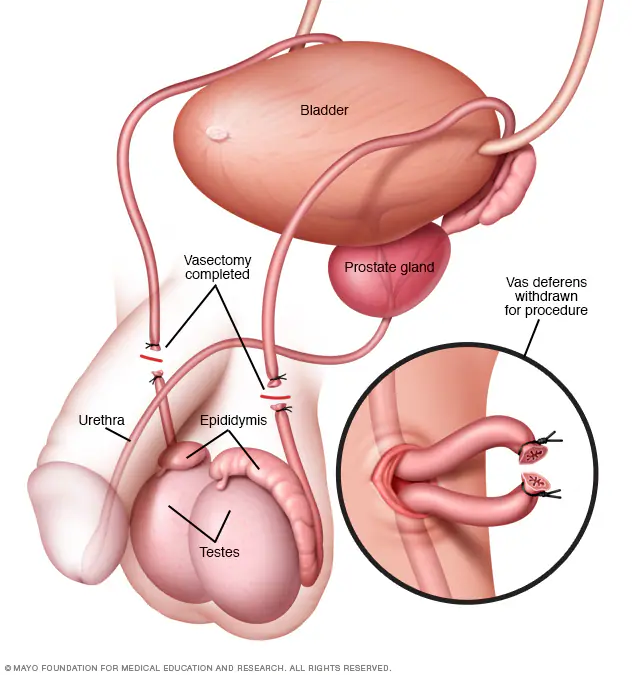 my00483_im03711_m7_vasectomy2thu_jpg.jpg