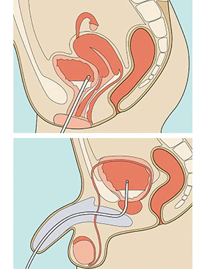 IC_retention_urinaire_inserer_une_sonde_urinaire.jpg