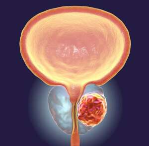 Prostate Cancer