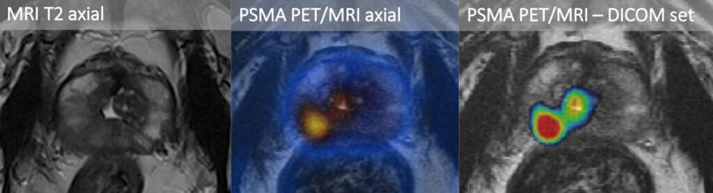 Prostate-PSMA-PET-CT-and-PET-MRI-09