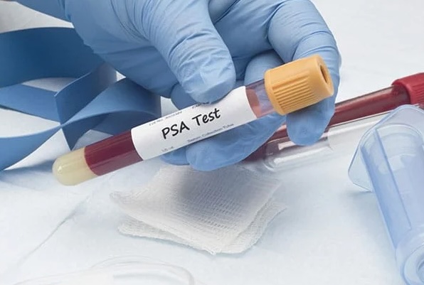 Le Cancer de la Prostate Le Cancer de la Prostate